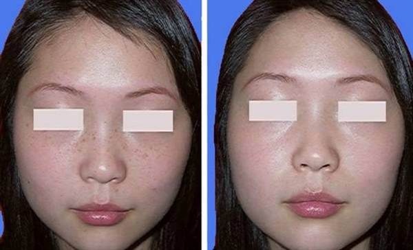 光子<a href=http://m.f3bb6.cn/listinfo-795-0.html target=_blank class=infotextkey>祛斑</a>美白的方法