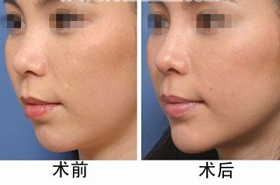 光纖<a href=http://m.f3bb6.cn/listinfo-682-0.html target=_blank class=infotextkey>溶脂</a><a href=http://m.f3bb6.cn/listinfo-631-0.html target=_blank class=infotextkey>瘦臉</a>要注意什么