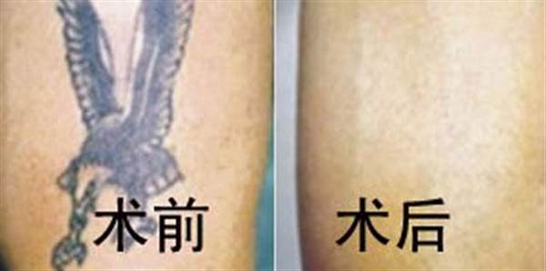 洗個紋身要多少錢