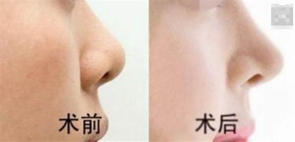 膨體<a href=http://m.f3bb6.cn/listinfo-737-0.html target=_blank class=infotextkey>隆鼻</a>可以長期嗎