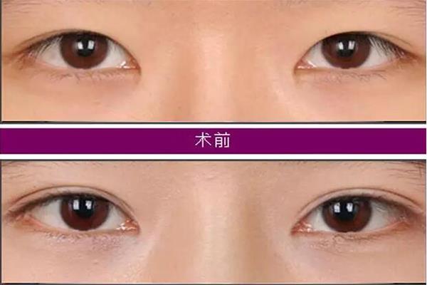 開內眼角圖片對比照片