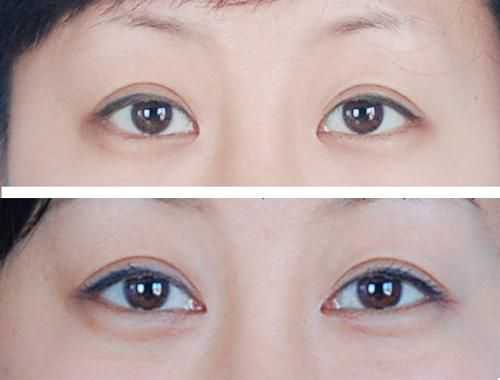 <a href=http://m.f3bb6.cn/listinfo-711-0.html target=_blank class=infotextkey>開眼角</a>前后對比圖