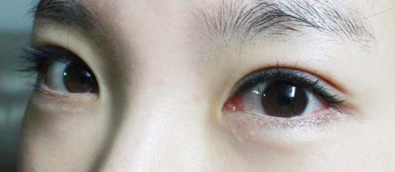 無痕開內眼角術中操作方法有哪些