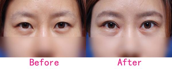 開內眼角失敗的修復方法是什么