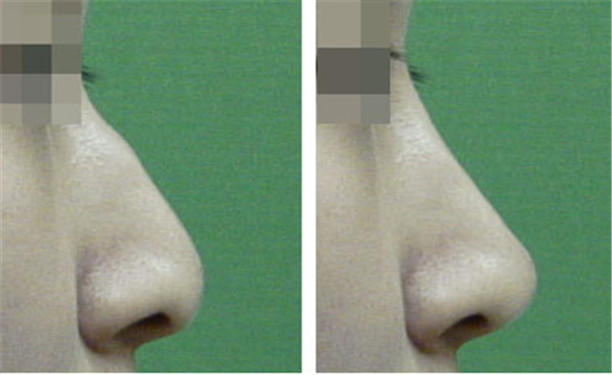 <a href=http://m.f3bb6.cn/listinfo-756-0.html target=_blank class=infotextkey>駝峰鼻矯正</a>恢復時間