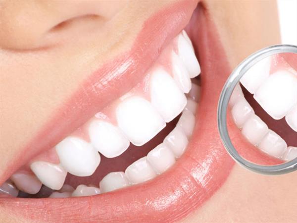 牙齒貼面可以維持多久
