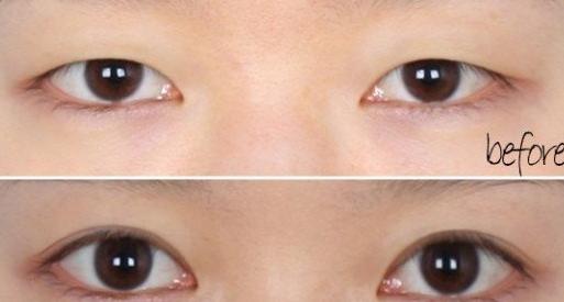 做上瞼提肌矯正術(shù)手術(shù)