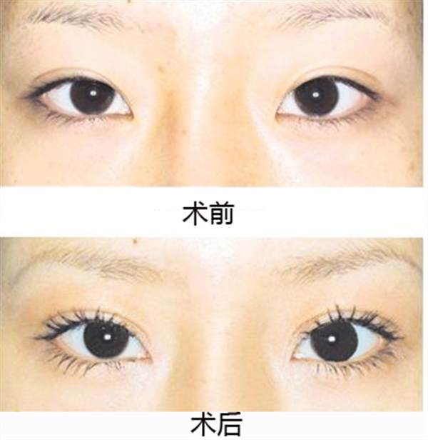 北京開內眼角哪里比較好