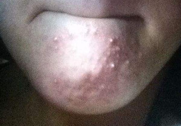 白頭粉刺怎么去除