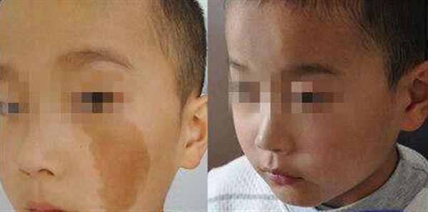 打胎記需要多少錢