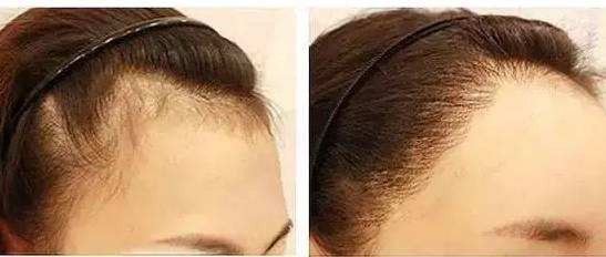 做<a href=http://m.f3bb6.cn/listinfo-664-0.html target=_blank class=infotextkey>毛發(fā)種植</a>手術需要多少錢