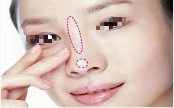 打波尿酸<a href=http://m.f3bb6.cn/listinfo-737-0.html target=_blank class=infotextkey>隆鼻</a>多少錢