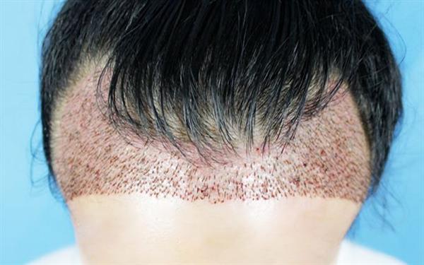 發際線種植費用是多少