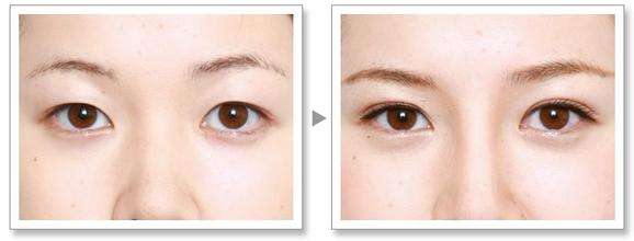 埋線<a href=http://m.f3bb6.cn/listinfo-724-0.html target=_blank class=infotextkey>雙眼皮</a>手術后都能恢復成原樣嗎