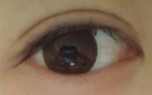 如何應對埋線<a href=http://m.f3bb6.cn/listinfo-724-0.html target=_blank class=infotextkey>雙眼皮</a>浮腫