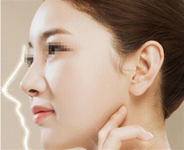 鼻骨整形手術有沒有副作用