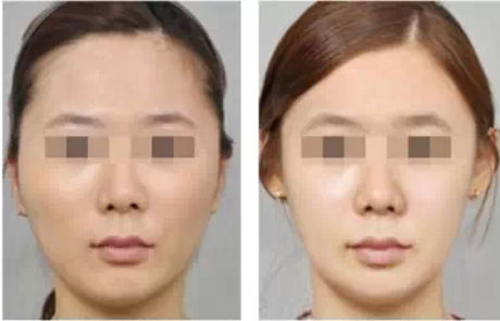 脂肪填充后多久能化妝