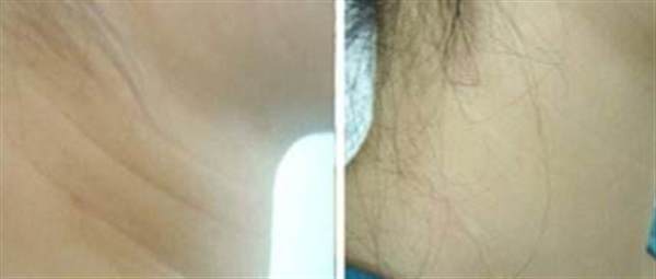 頸紋是怎么形成的