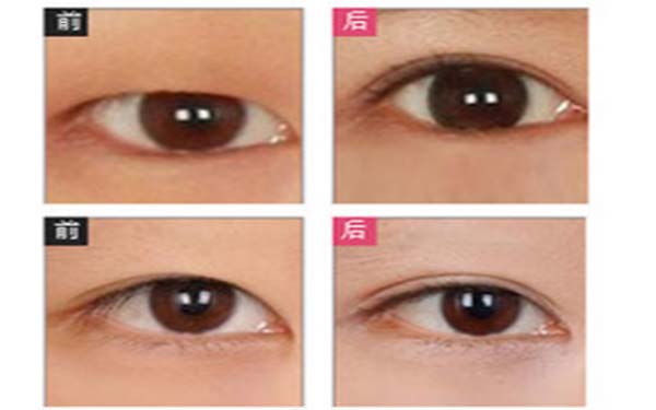 做<a href=http://m.f3bb6.cn/listinfo-724-0.html target=_blank class=infotextkey>雙眼皮</a>算整容嗎
