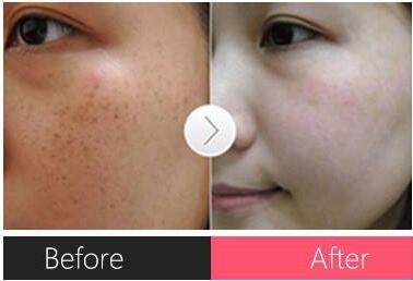 怎么<a href=http://m.f3bb6.cn/listinfo-795-0.html target=_blank class=infotextkey>祛斑</a>較好的方法