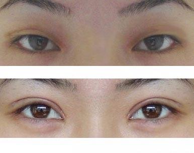 <a href=http://m.f3bb6.cn/listinfo-724-0.html target=_blank class=infotextkey>雙眼皮</a>埋線圖片前后對比