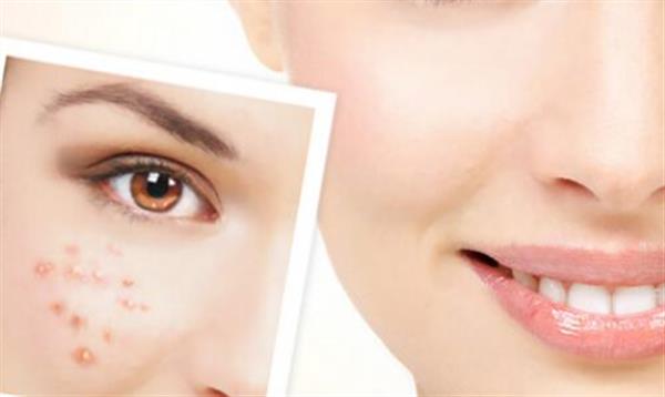 果酸換膚祛痘術前注意事項