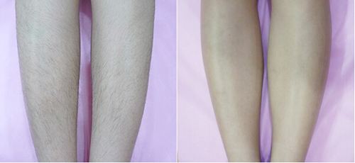 opt<a href=http://m.f3bb6.cn/listinfo-670-0.html target=_blank class=infotextkey>脫毛</a>與冰點<a href=http://m.f3bb6.cn/listinfo-670-0.html target=_blank class=infotextkey>脫毛</a>區別