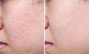 磨皮去痘坑多少錢