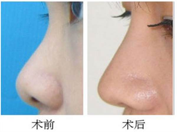 做一個假體鼻子多少錢