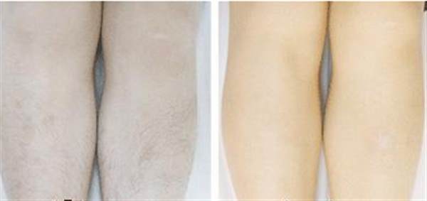 彩光<a href=http://m.f3bb6.cn/listinfo-770-0.html target=_blank class=infotextkey>嫩膚</a>效果可以持續多長時間