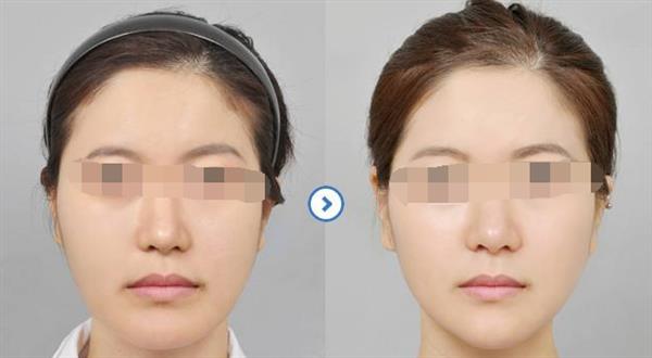 <a href=http://m.f3bb6.cn/listinfo-629-0.html target=_blank class=infotextkey>下頜角</a>整形術后恢復需要多久