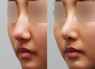 硅膠<a href=http://m.f3bb6.cn/listinfo-737-0.html target=_blank class=infotextkey>隆鼻</a>下滑幾率高嗎