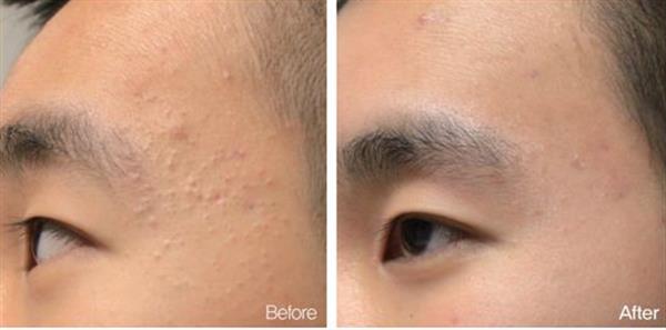 臉上長粉刺是什么原因怎樣去掉