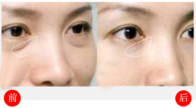 淚溝填充會腫幾天