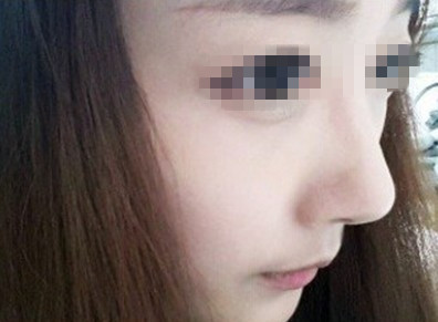 假體<a href=http://m.f3bb6.cn/listinfo-737-0.html target=_blank class=infotextkey>隆鼻</a>鼻頭又腫又硬