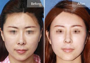 假體<a href=http://m.f3bb6.cn/listinfo-737-0.html target=_blank class=infotextkey>隆鼻</a>半個月恢復圖