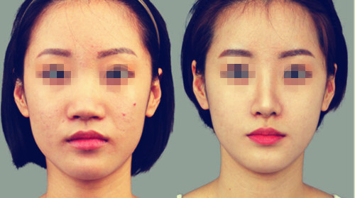 自體脂肪<a href=http://m.f3bb6.cn/listinfo-737-0.html target=_blank class=infotextkey>隆鼻</a>壞處