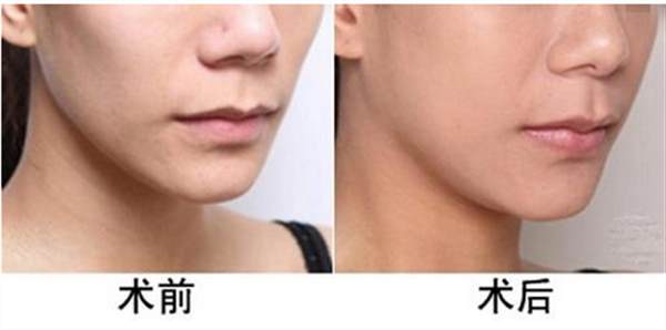 面部脂肪填充幾天恢復