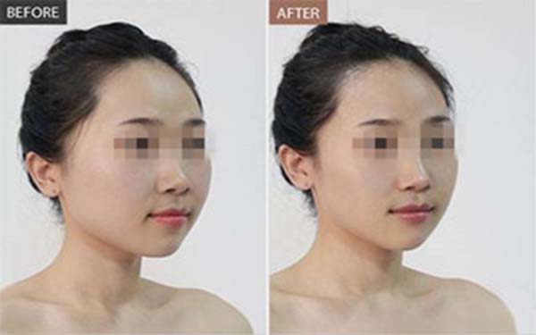 面部填充手術的費用