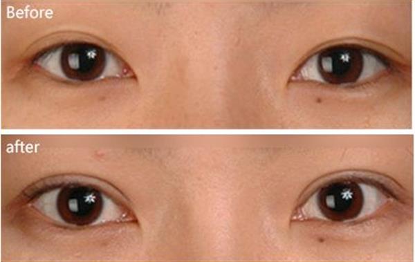 三點<a href=http://m.f3bb6.cn/listinfo-724-0.html target=_blank class=infotextkey>雙眼皮</a>后多久能恢復