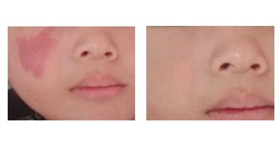 激光<a href=http://m.f3bb6.cn/listinfo-773-0.html target=_blank class=infotextkey>去胎記</a>會有疤嗎