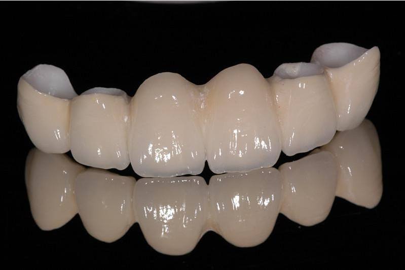 虎牙做烤瓷冠多少錢