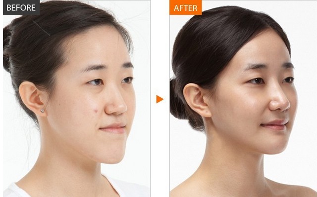 鼻子假體分幾種