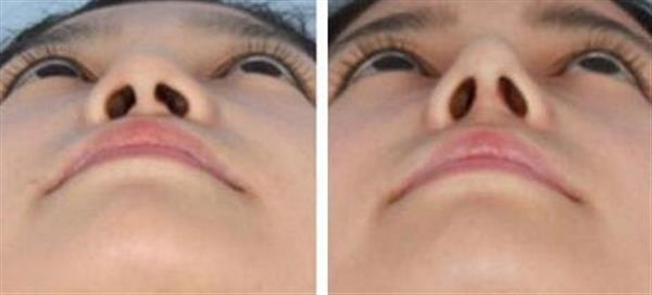 鼻子寬縮小有哪些方法