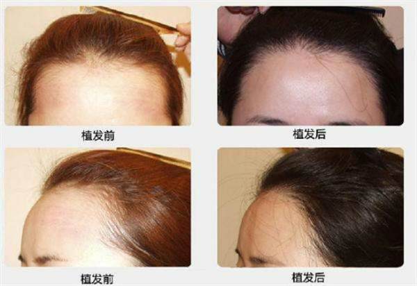 植發多久可以戴帽子