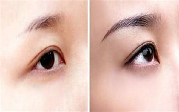 <a href=http://m.f3bb6.cn/listinfo-655-0.html target=_blank class=infotextkey>切眉</a>手術需要多少錢?