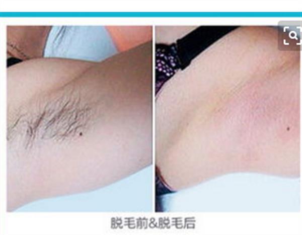 opt冰點<a href=http://m.f3bb6.cn/listinfo-670-0.html target=_blank class=infotextkey>脫毛</a>得危害