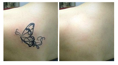 植皮<a href=http://m.f3bb6.cn/listinfo-793-0.html target=_blank class=infotextkey>洗紋身</a>一般多少錢