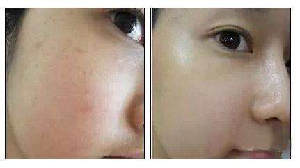 激光修復痘坑多少錢