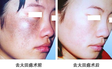 激光<a href=http://m.f3bb6.cn/listinfo-799-0.html target=_blank class=infotextkey>去太田痣</a>多少錢